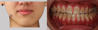 image 歯や顎が横にずれている場合の矯正治療