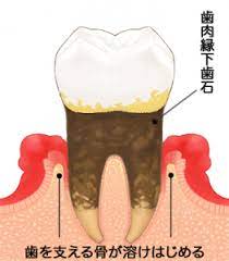 歯肉縁下歯石をとる歯周病専門医