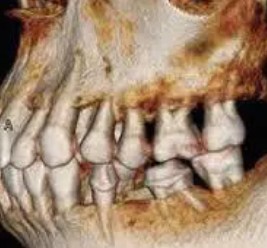 福岡市歯周病専門医による、歯周組織再生療法の3つの利点