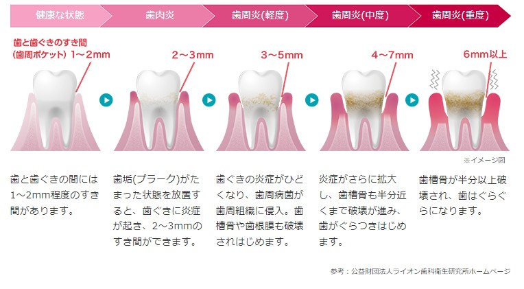 歯周病の進行状態
