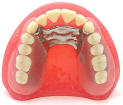 「ノンクラスプデンチャー＋金属」で”耐久性の高い”入れ歯を実現