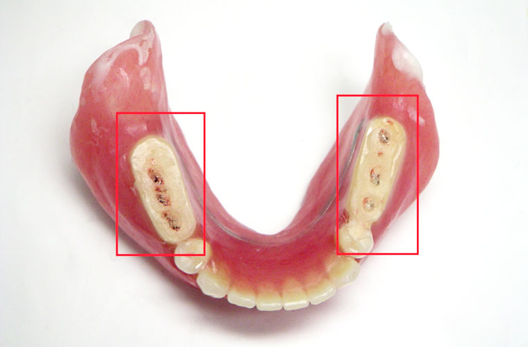 「診断用義歯」でお口の中の情報を読み取る