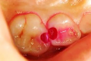 「う蝕検知液」を用いて”虫歯の取り残し・削りすぎ”を防ぐ