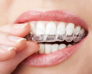 歯周病菌の除菌を行う「3DS療法」（dental drug delivery system）