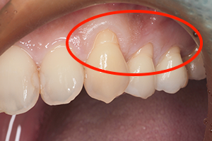 「歯肉移植手術」”歯ぐきの見た目”を改善する