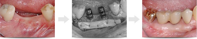 「歯肉移植手術」”歯ぐきの見た目”を改善する