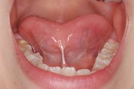 舌小帯　スマイルライン歯科・矯正歯科六本松