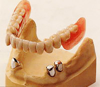 違和感が少なく見た目が美しい「コーヌスクローネ義歯」