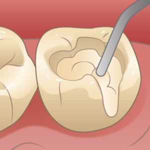 Cr コンポジットレジン充填 とは 佐世保市の歯医者 歯科医院