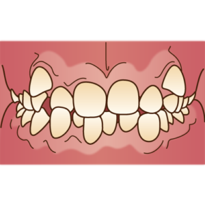 子供の歯列不正、歯の叢生