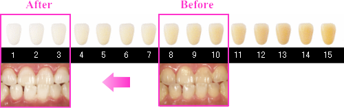 歯の色の評価とホワイトニング