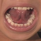 舌小帯手術後